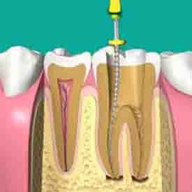 Comprehensive Root Canal Treatment in Bandar Rimbayu
