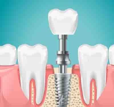 dental-implants