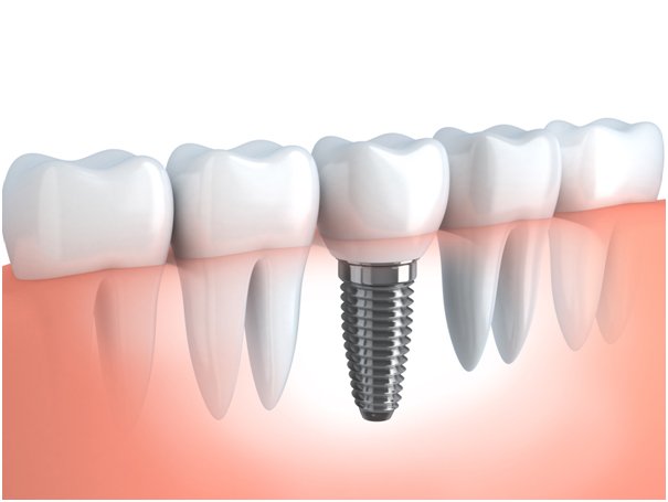 Implant-teeth-price-in-Malaysia