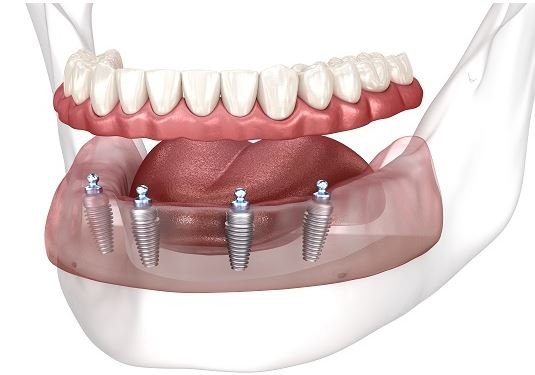 all-on-4-dental-implants