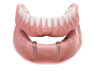 teeth-implants