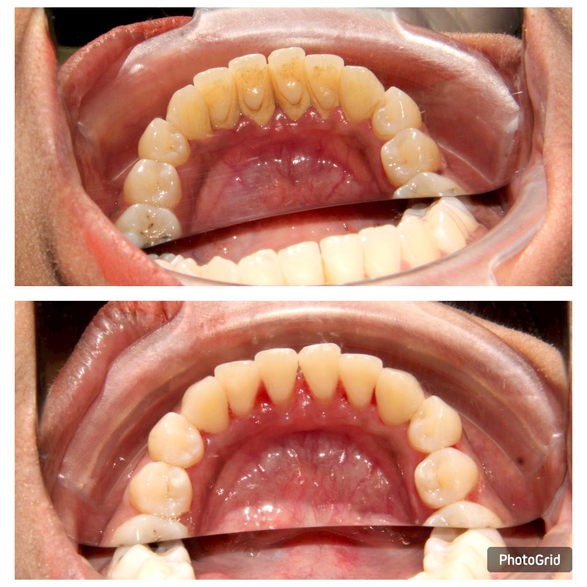teeth-scaling