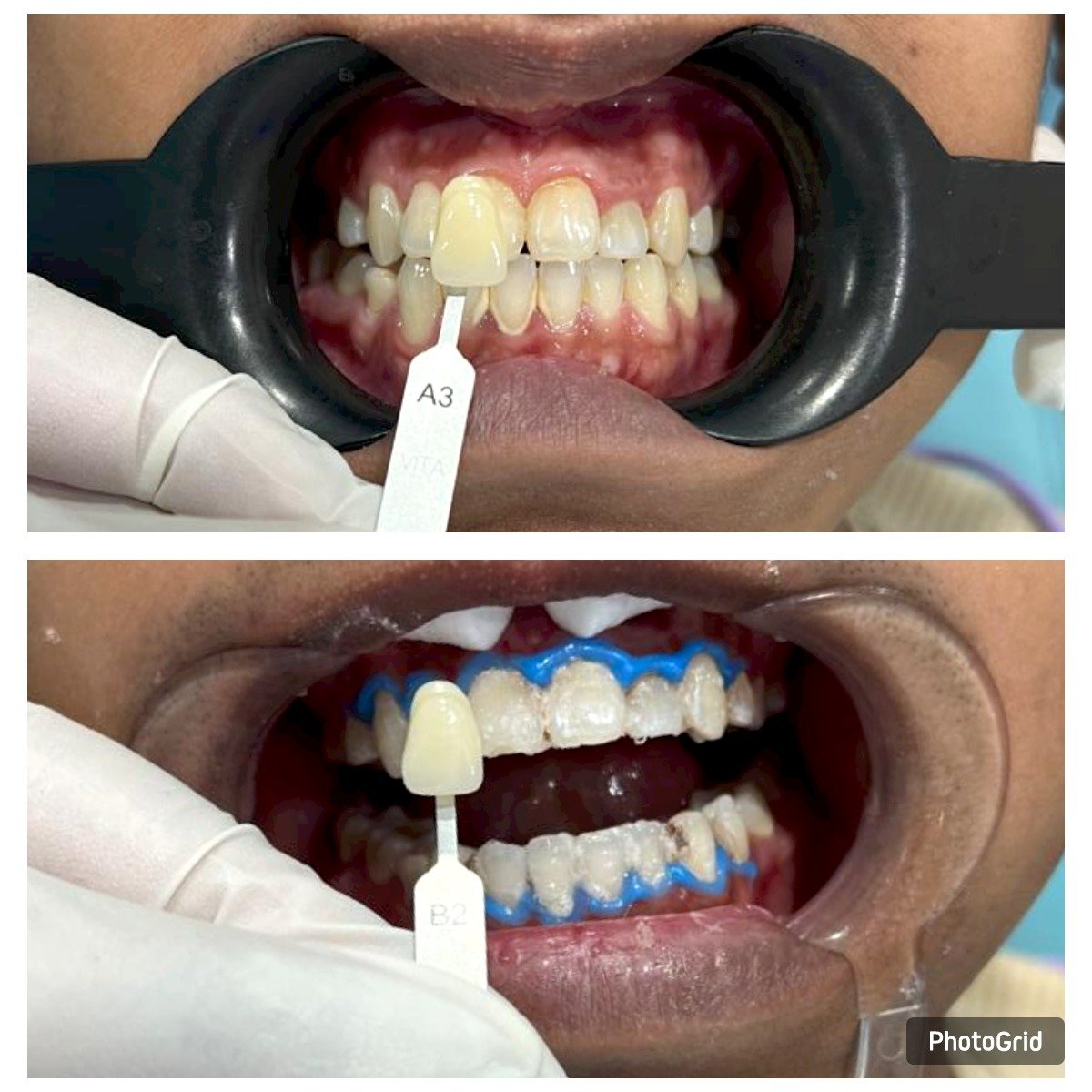 teeth-whitening